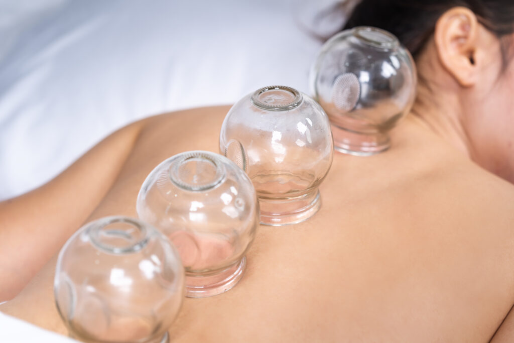 Cupping Leicester
