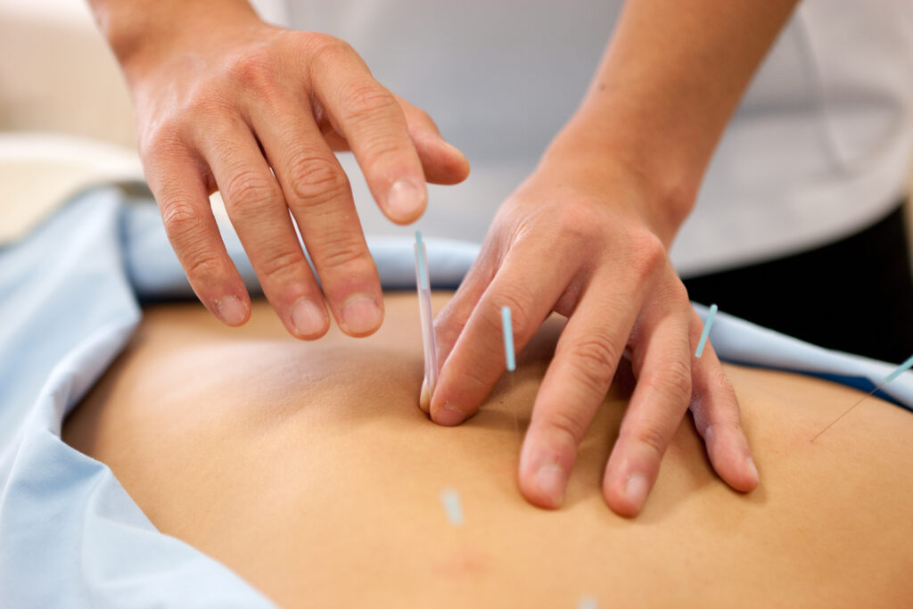 Traditional Acupuncture Leicester