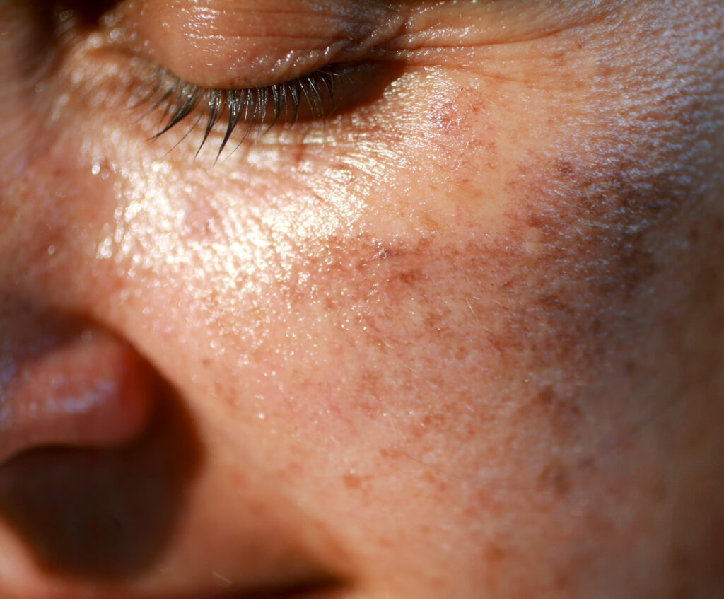 Skin Problems Leicester